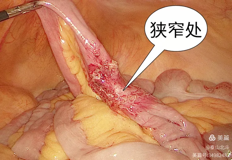 可见粘连致肠梗阻处小肠.腹壁切口疝,腹壁缺损直径约3.0cm